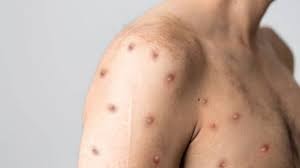 Ilustrasi cacar monyet 